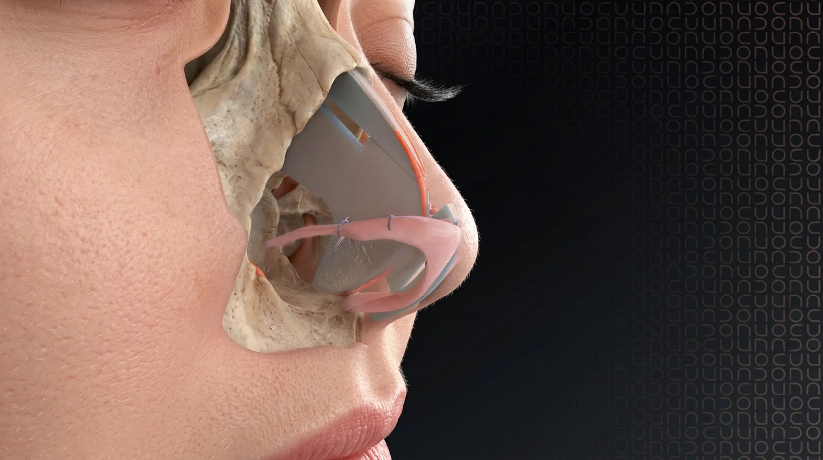 Technique de rhinoplastie par le docteur Nadon