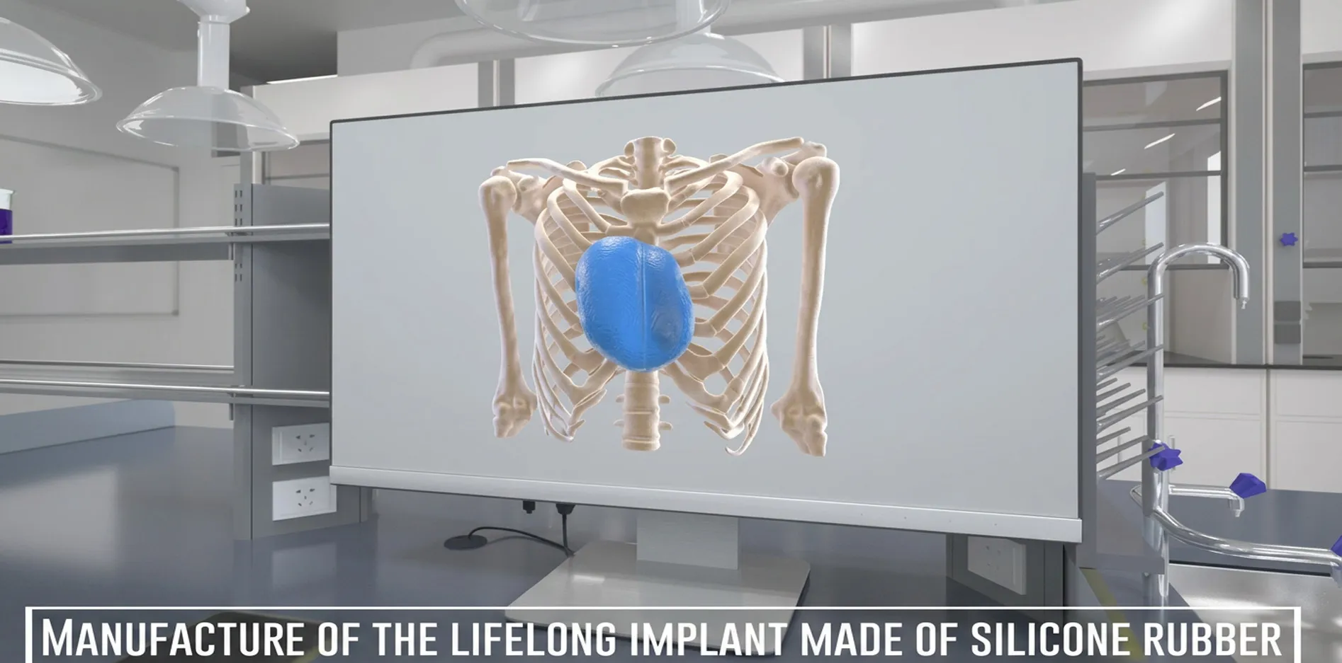 Conception d’implants 3D sur-mesure